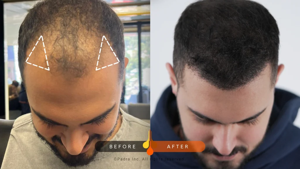 temple hair transplant before and after