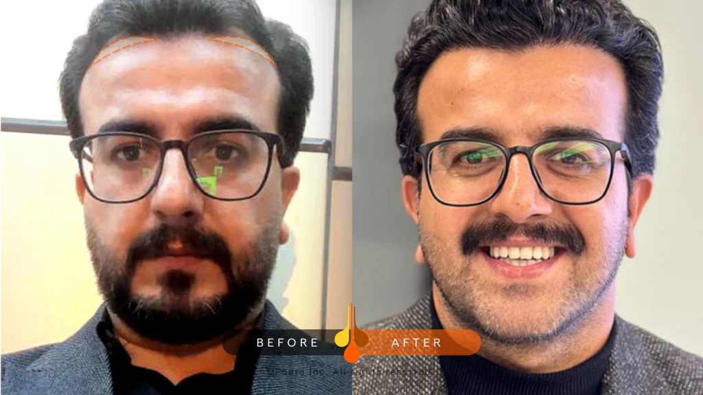 temple hair transplant before and after