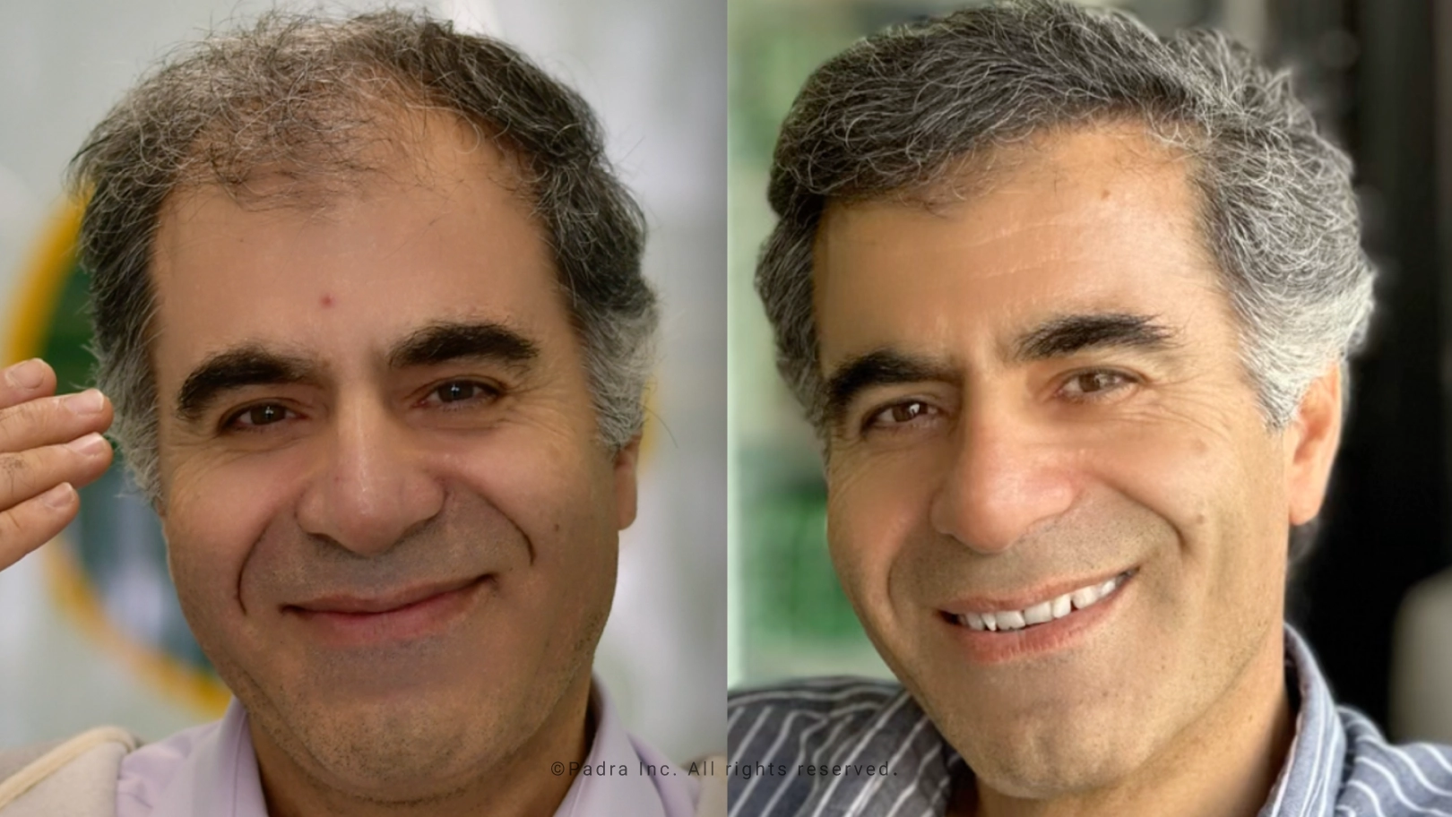 temple hair transplant