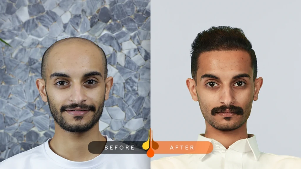دوام نتايج زراعة الشعر بعد كم سنة