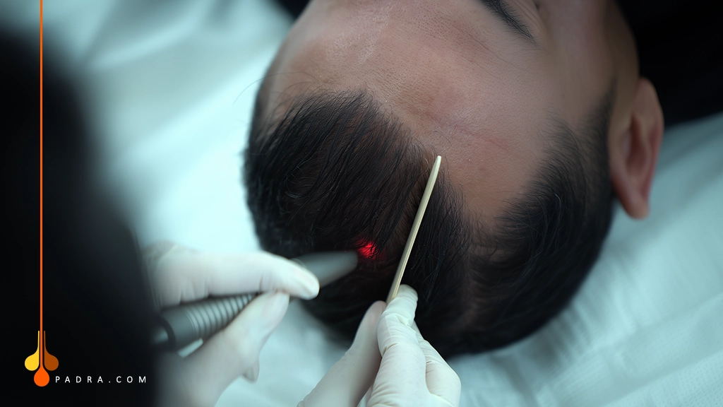 رعايات لدوام نتايج زراعة الشعر