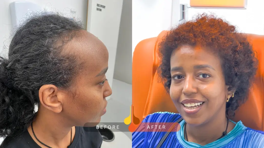 Successful women's hair transplant in Saudi Arabia