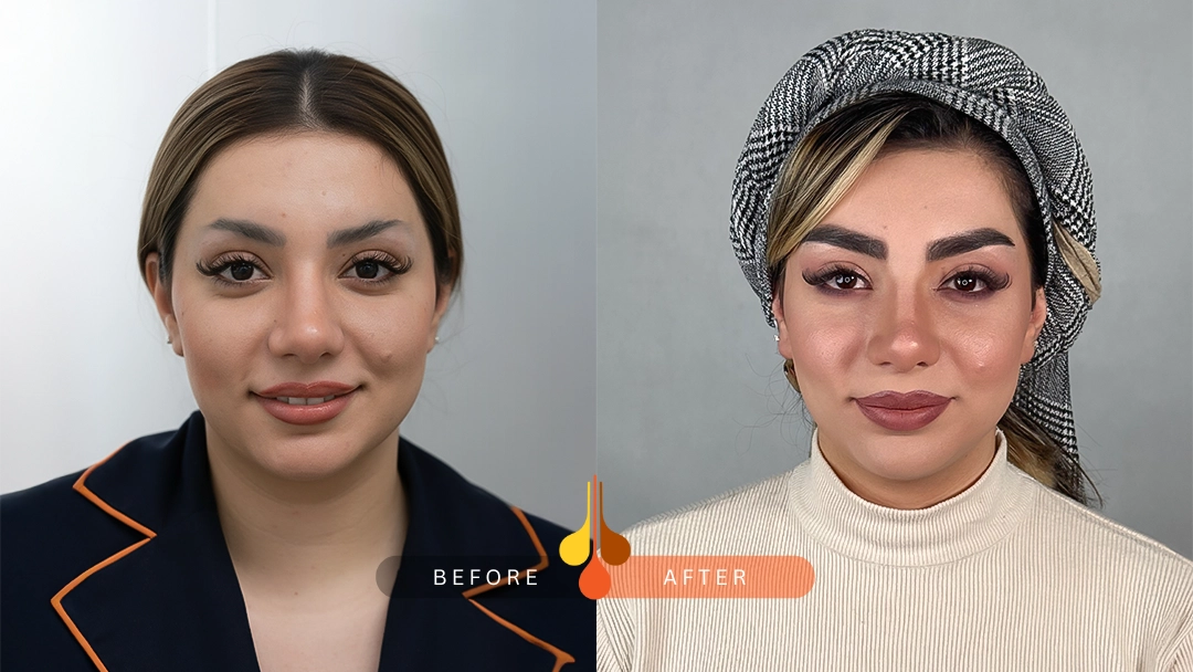 Real eyebrow transplant results at Padra Clinic Riyadh