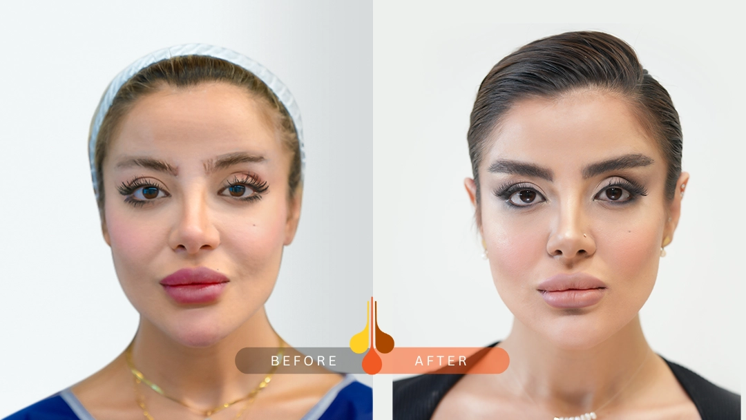 Real eyebrow transplant results at Padra Clinic Dubai