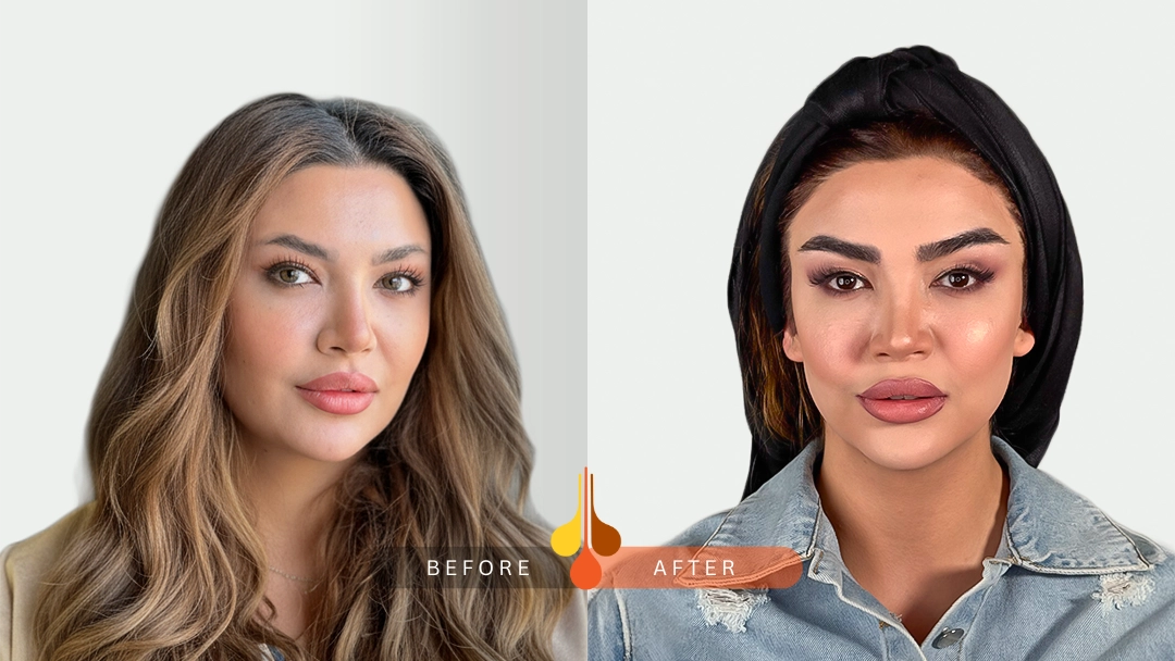 Before and after eyebrow transplant at Padra Clinic Dubai