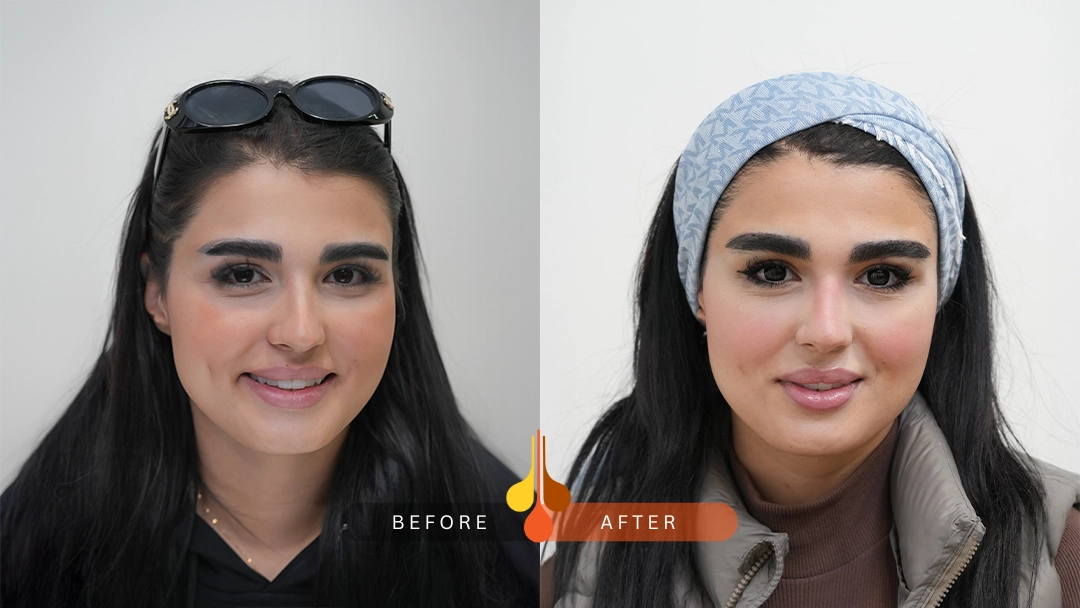 Before and after eyebrow transplant at Padra Clinic Dubai