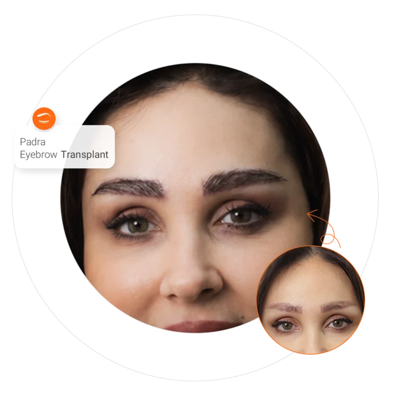 Eyebrow Transplant in Dubai