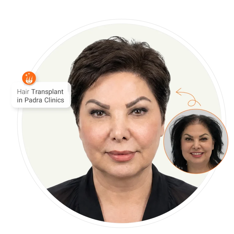 Natural women's hair transplant results in Dubai