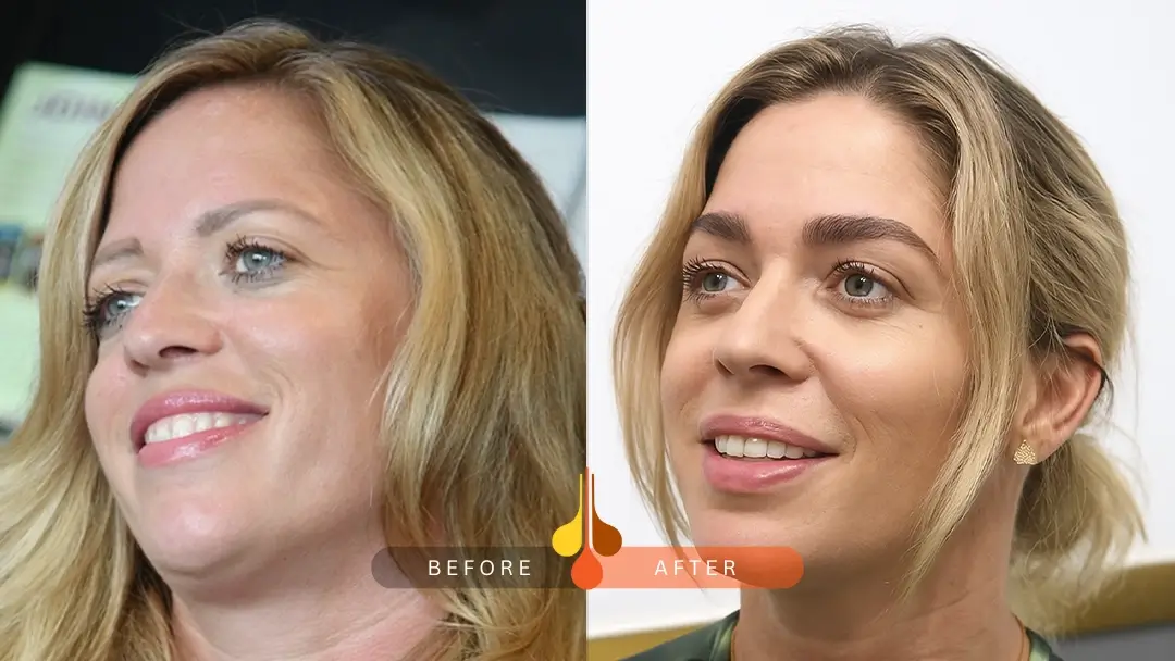 Eyebrow restoration before and after in Dubai