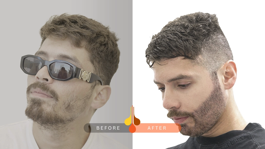 Successful beard restoration at Padra Clinic Dubai