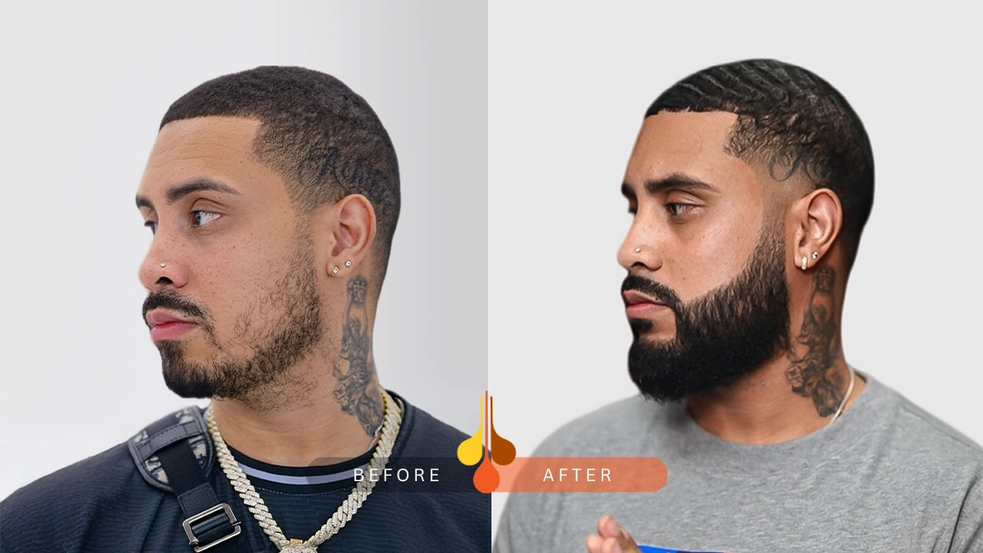 Before and after beard transplant at Padra Clinic Dubai