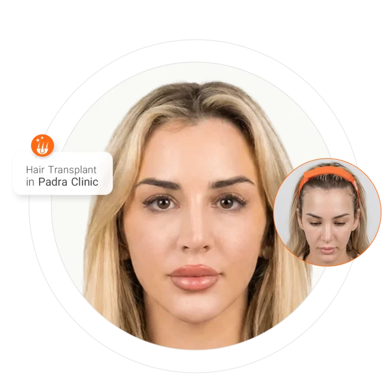 Before and after women's hair transplant at Padra Clinic Riyadh