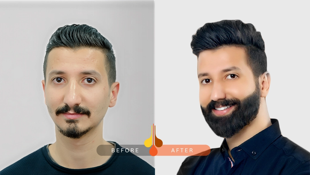 Natural beard transplant results in Dubai