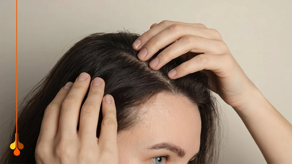 Female Hair Loss After Stopping Minoxidil