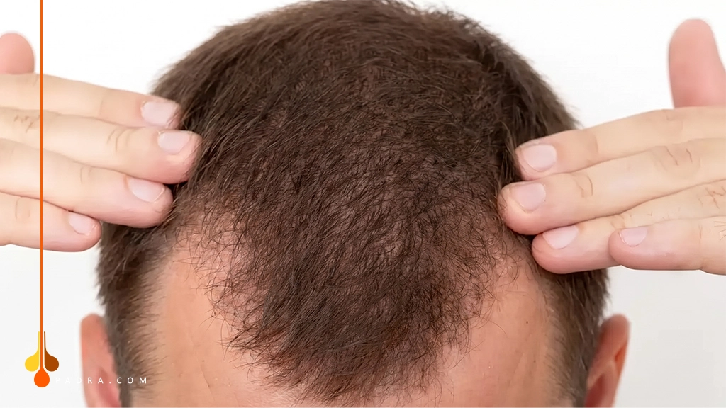 Hair Follicle Regeneration